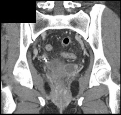 Prolapse - CTisus CT Scan