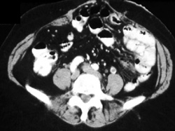 Left Gonadal Vein Thrombosis - CTisus CT Scan