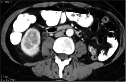 Gonadal Vein Thrombosis - CTisus CT Scan