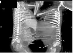 Conjoined Twins - CTisus CT Scan