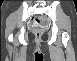 Ulcerating Mass Off Vulva - CTisus CT Scan