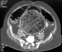 Dilated Rectum With Stool - CTisus CT Scan