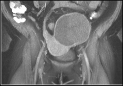 Cystadenoma - CTisus CT Scan