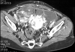 Ovarian Carcinoma With Calcification - CTisus CT Scan