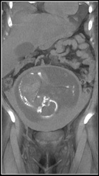 Intrauterine Pregnancy - CTisus CT Scan