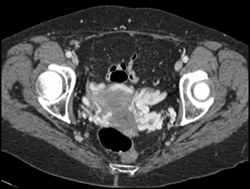 Enlarged Gonadal Veins and Pelvic Venous Congestion - CTisus CT Scan