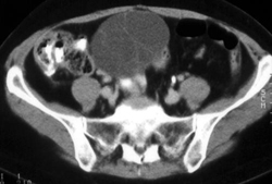 Cystadenocarcinoma - CTisus CT Scan