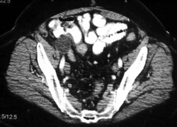 Seroma - CTisus CT Scan