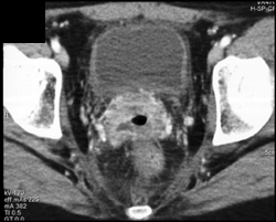 Cervical Cancer With Parametrial Spread - CTisus CT Scan