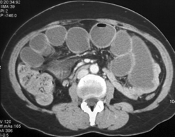 Small Bowel Obstruction (SBO) Due to Endometriosis Involving the Terminal Ileum - CTisus CT Scan