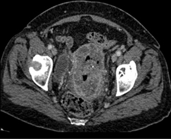 Necrotic Cervical Cancer - CTisus CT Scan