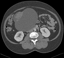 Ovarian Cancer - CTisus CT Scan