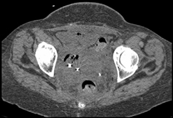 Pelvic Infiltration By Tumor - CTisus CT Scan