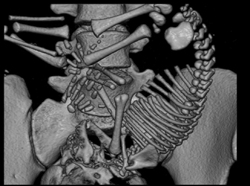 In Utero Pregnancy - CTisus CT Scan