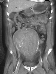 Enlarged Uterus Postpartum - CTisus CT Scan