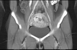 Arteriovenous Malformation (AVM) Uterus - CTisus CT Scan