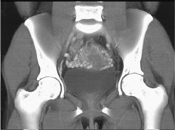 Gestational Trophoblastic Disease - CTisus CT Scan