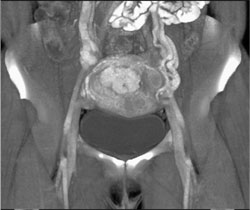 Gestational Trophoblastic Disease - CTisus CT Scan