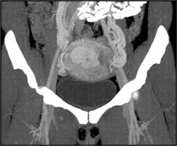 Gestational Trophoblastic Disease - CTisus CT Scan