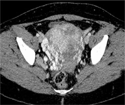 Gestational Trophoblastic Disease - CTisus CT Scan