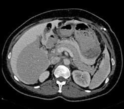 Intraperitoneal Chemotherapy for Ovarian Cancer Shows Spread Pattern of Ascites - CTisus CT Scan