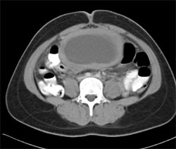 Dilated Uterus Due to Cervical Stenosis - CTisus CT Scan