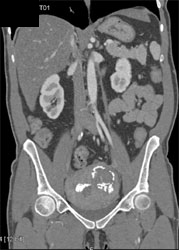 Calcified Fibroids - CTisus CT Scan