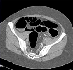 Endometriosis Simulates Cancer of Descending Colon - CTisus CT Scan