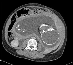 Pregnant Uterus With Placenta - CTisus CT Scan