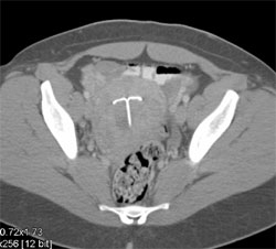 IUD - CTisus CT Scan