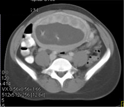 Placenta and Fetus - CTisus CT Scan