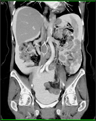 Peritoneal Contrast in Patient With Ovarian Cancer - CTisus CT Scan