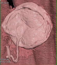 Normal Placenta in 3D - CTisus CT Scan