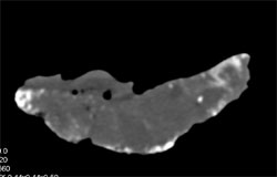 Aged Placenta With Calcification - CTisus CT Scan