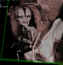 Fetus on the Run - CTisus CT Scan