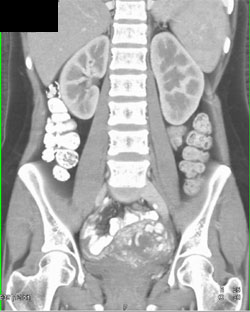 Gestational Trophoblastic Disease - CTisus CT Scan