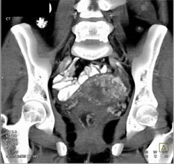 Gestational Trophoblastic Disease - CTisus CT Scan