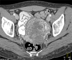 Gestational Trophoblastic Disease - CTisus CT Scan