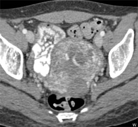 Gestational Trophoblastic Disease - CTisus CT Scan