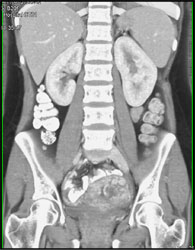 Gestational Trophoblastic Disease - CTisus CT Scan