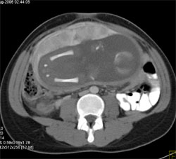 Fetus in Utero - CTisus CT Scan