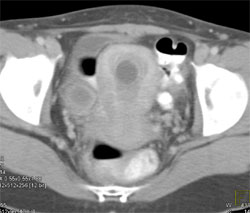 In Utero Fetus - CTisus CT Scan