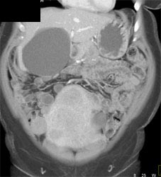 Degenerating Fibroids - CTisus CT Scan