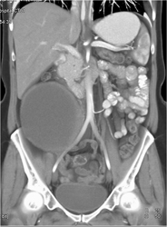 Ectopic Ovarian Tissue Representing Ovarian Cancer - CTisus CT Scan