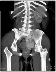 Arteriovenous Malformation (AVM) With Drainage Into IVC - CTisus CT Scan