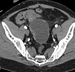 Dilated Uterus With Cervical Cancer - CTisus CT Scan