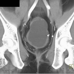 Obstructed Rectum Due to Rectal Cancer - CTisus CT Scan