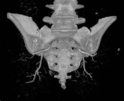 Pelvic Arterial Mapping of Inferior Gluteal Arteries - CTisus CT Scan