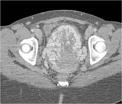 Gestational Trophoblastic Disease - CTisus CT Scan