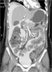 Intraperitoneal Chemotherapy - CTisus CT Scan